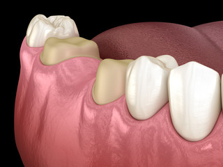 Preparated molar and premolar tooth for dental bridge placement. Medically accurate 3D illustration