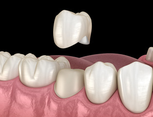 Preparated premolar tooth for dental crown placement. Medically accurate 3D illustration