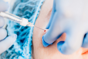 The procedure for the introduction of the active substance - under the skin, in pre-marked areas, injections of gualuronic acid are made - an ultrafine needle is used