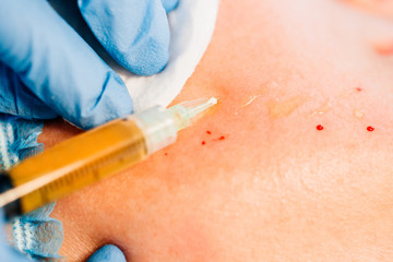 Plasma lifting - close-up doctor injects blood plasma under the patient’s skin to the cheekbone...