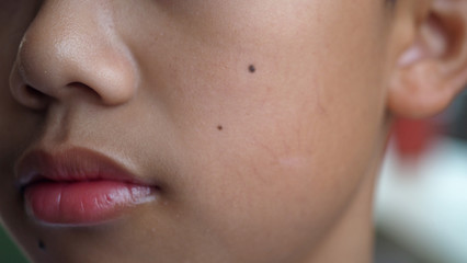 Closeup of an Asian boy face with black moles on his face. Selected focus.