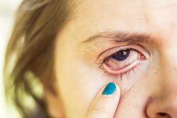 Eye of a young woman with red blood vessels showing on her sclera having glaucoma causing bad vision