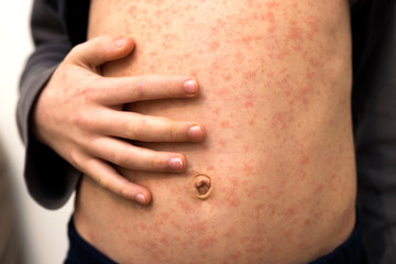 Sick child body, stomach with red rush spots from measles or chicken pox. Contagious child diseases and treatment. - obrazy, fototapety, plakaty
