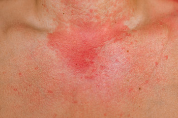 Fototapeta premium Allergic skin reaction on the man neck and face - red rash