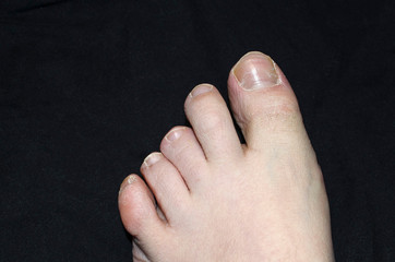 Fungal infection on human toenail. Toenail infection
