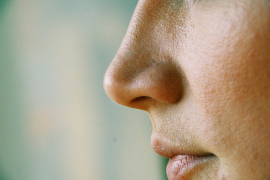 enlarged pores on the girl's face close up
