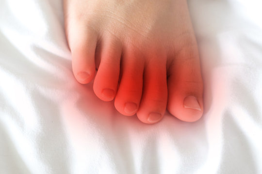 Foot of female Asia young adult with red spot as suffer from feet diseases