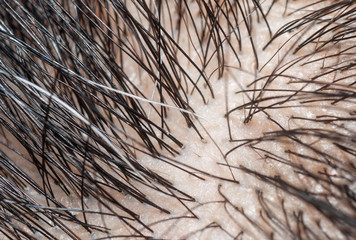 Macro photography of gray hair and black hair on Scalp. - obrazy, fototapety, plakaty