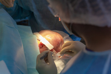 Baldness treatment. Hair transplant. Surgeons in the operating room carry out hair transplant...