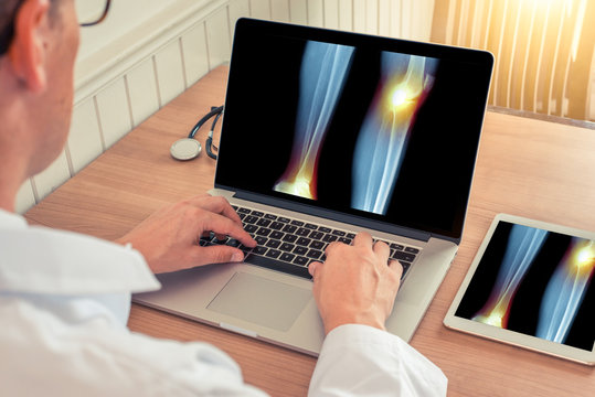 Doctor watching a laptop and digital tablet with x-ray of legs with pain relief on the knee and ankle in a medical office