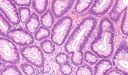 Microscopic (histology) of tubular adenoma. Adenomas are premalignant (precancerous) polyps of...