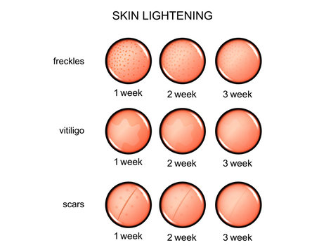 lightening of the skin. freckles, vitiligo, scars