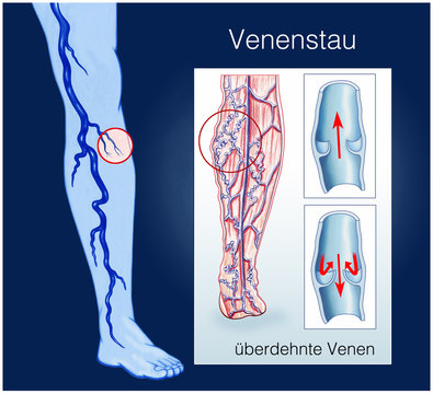 Krampfadern und Venenstau