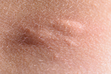 Fototapeta premium Swollen skin after a mosquito bite. Blisters appeared at the site of the mosquito bite. Close up macro