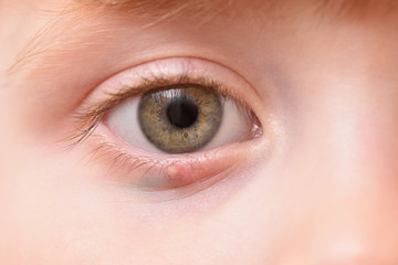 Children's right eye and swollen barley on the lower eyelid. Macro, close-up