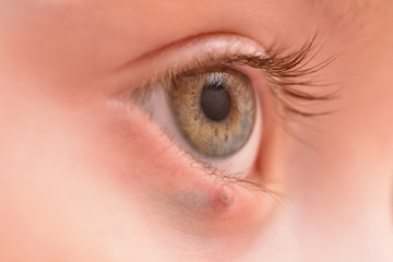 Obraz premium Children's right eye and swollen barley on the lower eyelid. Macro, close-up