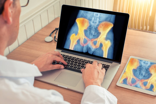 Doctor watching a laptop with x-ray of hips with pain relief in a medical office