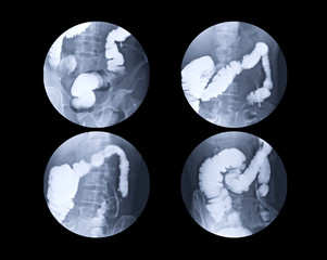 spot film of BE or. barium enema Single contrast image showing a rectal injection of barium...