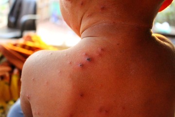 The boy had skin ulcers due to chickenpox infection