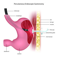 Percutaneous Endoscopic Gastronomy