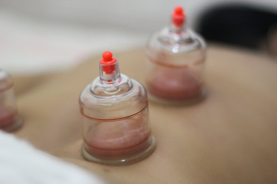 A person receiving chinese medicine treatment with suction cups. Vacuum cup of medical cupping therapy on back.