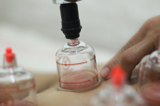 A Person Receiving Chinese medicine treatment with suction cups, Acupuncture therapist placing cup on the back.