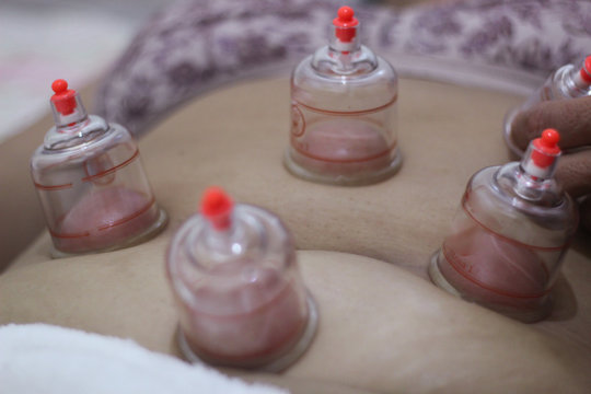 A person receiving chinese medicine treatment with suction cups. Multiple vacuum cup of medical cupping therapy on back.