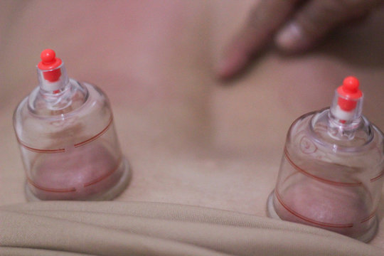 A person receiving chinese medicine treatment with suction cups. Vacuum cup of medical cupping therapy on back.