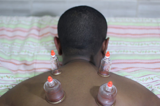 Young man receiving chinese medicine treatment with suction cups, Cupping Treatment On Back