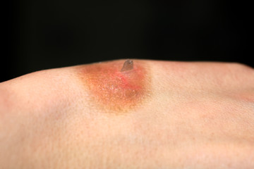 Fototapeta premium Burn on the hand. Brown spot on skin after burn