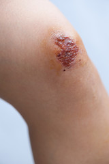 Fototapeta premium Fresh wound on asian female knee