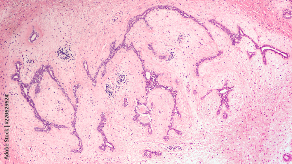 Wall mural breast biopsy: microscopic image (photomicrograph) of a fibroadenoma, a benign circumscribed tumor c