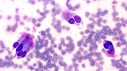 Photomicrograph of specimen obtained by bronchoscopy, a type of endoscopy of lung, showing clusters of ciliated columnar epithelial cells.  The cilia help sweep inhaled particulates out of the airway.