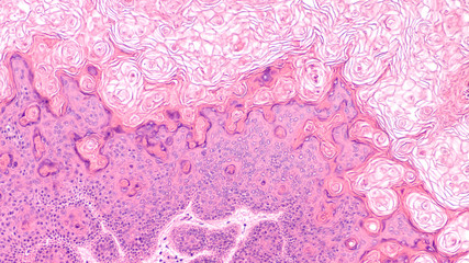 Microscopic image of a proliferating epidermoid cyst, a type of epidermal inclusion cyst (commonly...