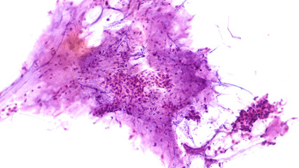 Fine needle aspiration (FNA) cytology of pleomorphic adenoma ("mixed tumor") of salivary gland, with stromal and epithelial elements. They may occur in the parotid, submandibular or sublingal glands.