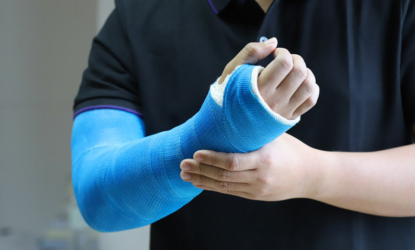 Closeup of Asian man's arm with long arm plaster, fiberglass cast therapy cover by blue elastic bandage after sport injury.