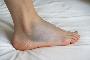 Sprained ankle with bruise adn swelling, female right foot - obrazy, fototapety, plakaty