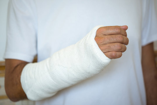 Plaster cast arm, adult man, white dressed