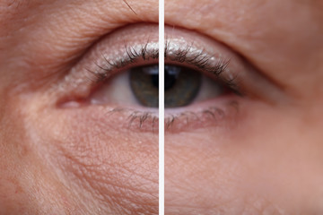Eye Bags Before And After Cosmetic Treatment