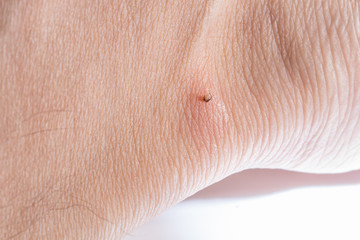 Sucking tick Macro photo on human skin