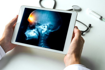 Doctor watching a x-ray of pain on a forehead of a skull on digital tablet. Meningitis migraine or...