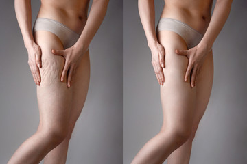 The woman shows cellulite and smooth and delicate skin on her legs. The concept of aesthetic medicine and skin imperfections. Before and after - obrazy, fototapety, plakaty