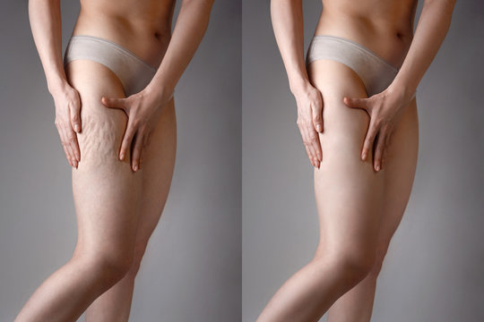 The woman shows cellulite and smooth and delicate skin on her legs. The concept of aesthetic medicine and skin imperfections. Before and after
