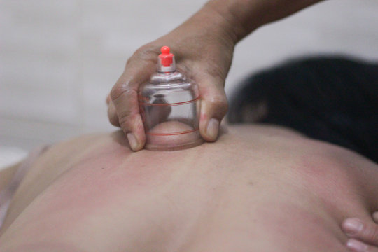 A person receiving chinese medicine treatment with suction cups. Vacuum cup of medical cupping therapy on back.