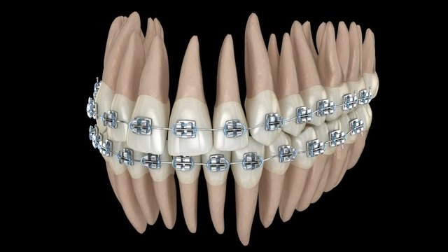 Abnormal teeth position and correction with metal braces tretament. Medically accurate dental 3D animation