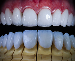 20 unit full ceramic veneers