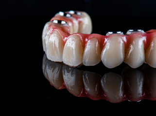 full arch ceramic bridge on implants © Garo