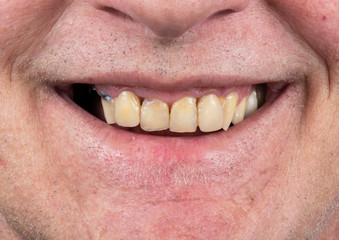 Obraz premium full arch ceramic veneers
