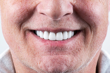 full arch ceramic veneers © Garo