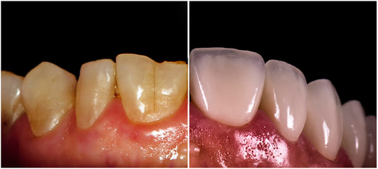 full ceramic veneers before and after